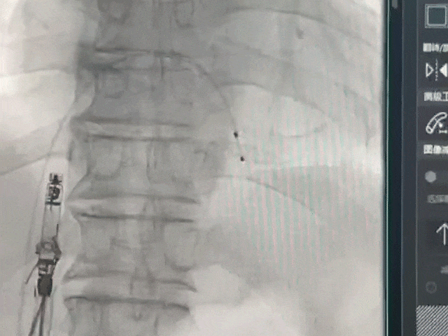 心脏是怎么固定的山西省心血管病医院心内4病区在超声指导下穿刺成功植入 主动螺旋固定式无导线心脏起搏器_https://www.jmylbn.com_新闻资讯_第19张