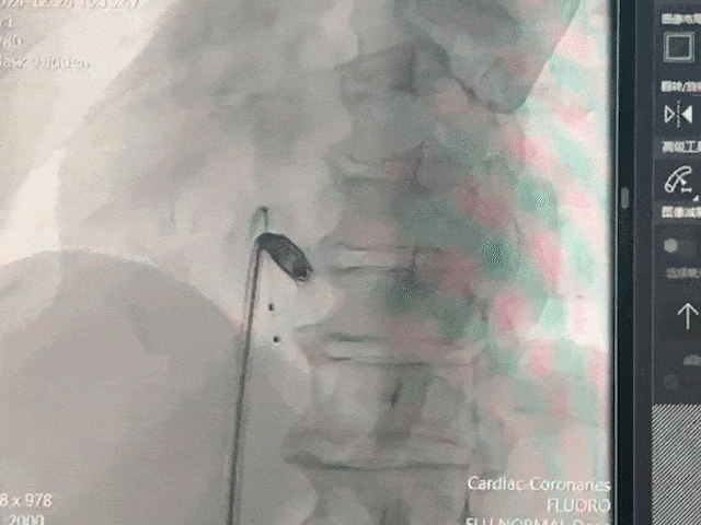 心脏是怎么固定的山西省心血管病医院心内4病区在超声指导下穿刺成功植入 主动螺旋固定式无导线心脏起搏器_https://www.jmylbn.com_新闻资讯_第18张