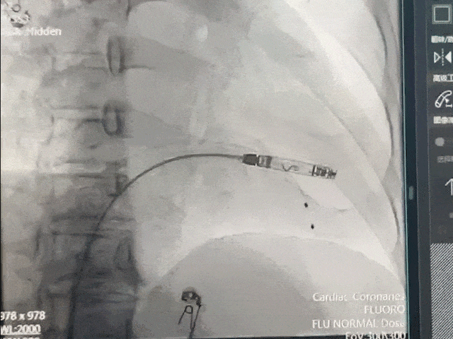 心脏是怎么固定的山西省心血管病医院心内4病区在超声指导下穿刺成功植入 主动螺旋固定式无导线心脏起搏器_https://www.jmylbn.com_新闻资讯_第20张