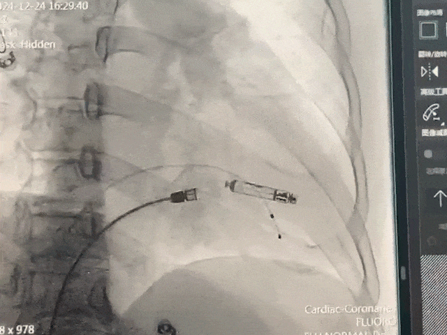 心脏是怎么固定的山西省心血管病医院心内4病区在超声指导下穿刺成功植入 主动螺旋固定式无导线心脏起搏器_https://www.jmylbn.com_新闻资讯_第23张