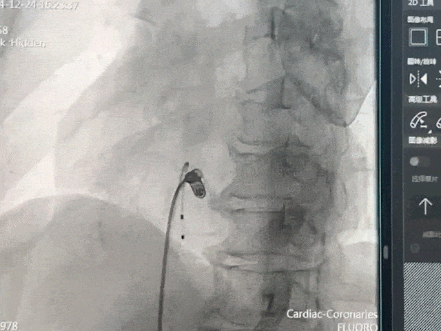 心脏是怎么固定的山西省心血管病医院心内4病区在超声指导下穿刺成功植入 主动螺旋固定式无导线心脏起搏器_https://www.jmylbn.com_新闻资讯_第22张