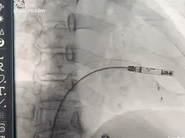 心脏是怎么固定的山西省心血管病医院心内4病区在超声指导下穿刺成功植入 主动螺旋固定式无导线心脏起搏器_https://www.jmylbn.com_新闻资讯_第21张