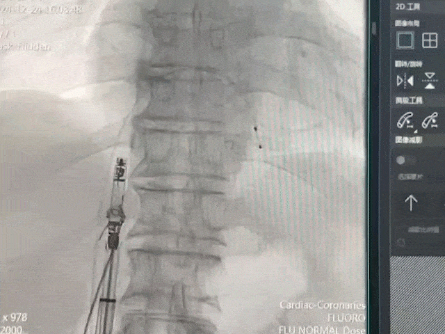 心脏是怎么固定的山西省心血管病医院心内4病区在超声指导下穿刺成功植入 主动螺旋固定式无导线心脏起搏器_https://www.jmylbn.com_新闻资讯_第14张