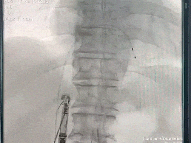 心脏是怎么固定的山西省心血管病医院心内4病区在超声指导下穿刺成功植入 主动螺旋固定式无导线心脏起搏器_https://www.jmylbn.com_新闻资讯_第13张