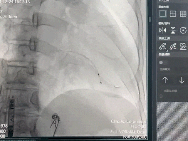 心脏是怎么固定的山西省心血管病医院心内4病区在超声指导下穿刺成功植入 主动螺旋固定式无导线心脏起搏器_https://www.jmylbn.com_新闻资讯_第15张