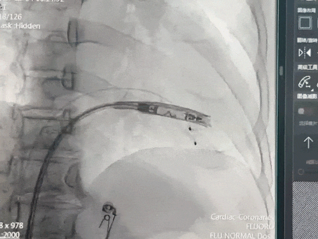 心脏是怎么固定的山西省心血管病医院心内4病区在超声指导下穿刺成功植入 主动螺旋固定式无导线心脏起搏器_https://www.jmylbn.com_新闻资讯_第17张