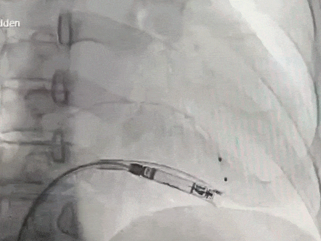 心脏是怎么固定的山西省心血管病医院心内4病区在超声指导下穿刺成功植入 主动螺旋固定式无导线心脏起搏器_https://www.jmylbn.com_新闻资讯_第16张