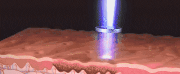 二氧化碳(co2)激光治疗是什么二氧化碳（CO₂）点阵激光，除了治疗痘坑还有哪些功能？_https://www.jmylbn.com_新闻资讯_第3张