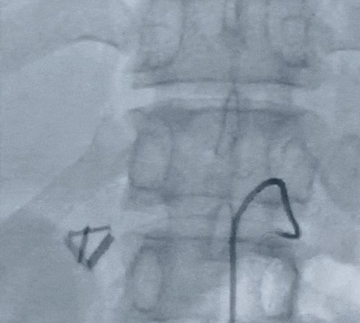 不会导管导丝基本操作?