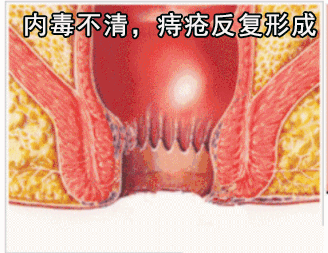 促愈凝胶怎么排出「DR.ROTUS卡波姆痔疮凝胶」消肿止痛，止血止痒，促进愈合_https://www.jmylbn.com_新闻资讯_第18张