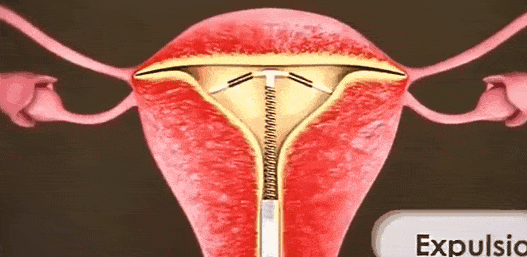 所谓"环",指的是"宫内节育器(iud)",按材料主要可分为惰性和活性两类.