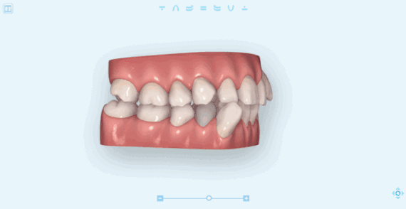 隐形矫正支抗钉临床操作指南