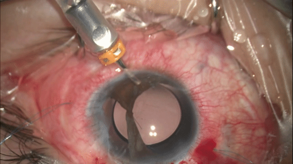 开睑器怎么用术说睛彩 ｜ 金海鹰教授：使用8-0缝线的无巩膜瓣人工晶体固定手术_https://www.jmylbn.com_新闻资讯_第8张