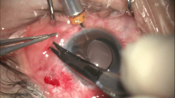 开睑器怎么用术说睛彩 ｜ 金海鹰教授：使用8-0缝线的无巩膜瓣人工晶体固定手术_https://www.jmylbn.com_新闻资讯_第15张