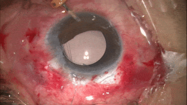 开睑器怎么用术说睛彩 ｜ 金海鹰教授：使用8-0缝线的无巩膜瓣人工晶体固定手术_https://www.jmylbn.com_新闻资讯_第23张