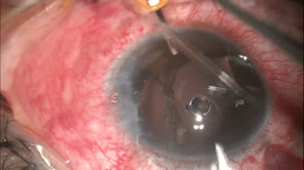 开睑器怎么用术说睛彩 ｜ 金海鹰教授：使用8-0缝线的无巩膜瓣人工晶体固定手术_https://www.jmylbn.com_新闻资讯_第3张