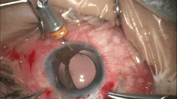 开睑器怎么用术说睛彩 ｜ 金海鹰教授：使用8-0缝线的无巩膜瓣人工晶体固定手术_https://www.jmylbn.com_新闻资讯_第9张