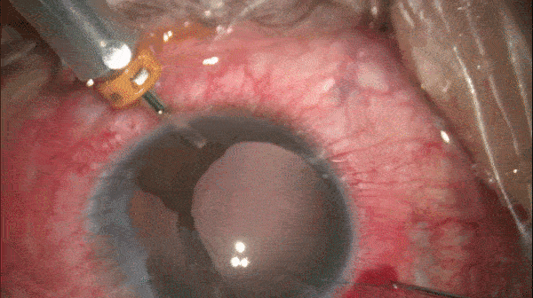 开睑器怎么用术说睛彩 ｜ 金海鹰教授：使用8-0缝线的无巩膜瓣人工晶体固定手术_https://www.jmylbn.com_新闻资讯_第4张