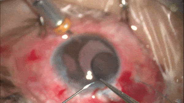 开睑器怎么用术说睛彩 ｜ 金海鹰教授：使用8-0缝线的无巩膜瓣人工晶体固定手术_https://www.jmylbn.com_新闻资讯_第7张