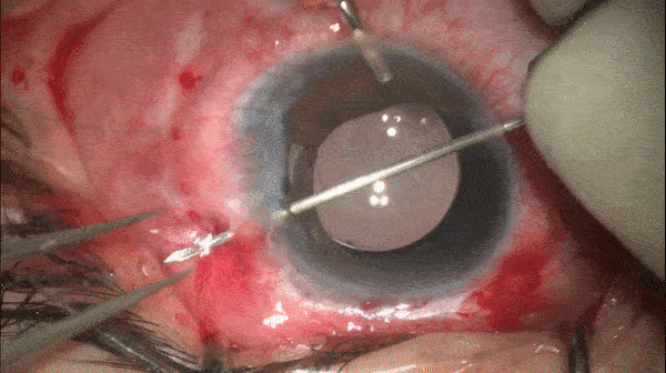 开睑器怎么用术说睛彩 ｜ 金海鹰教授：使用8-0缝线的无巩膜瓣人工晶体固定手术_https://www.jmylbn.com_新闻资讯_第19张