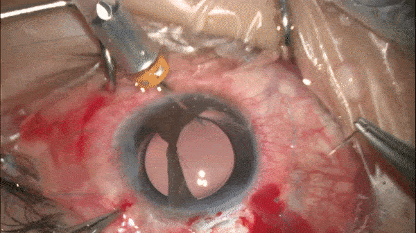 开睑器怎么用术说睛彩 ｜ 金海鹰教授：使用8-0缝线的无巩膜瓣人工晶体固定手术_https://www.jmylbn.com_新闻资讯_第10张