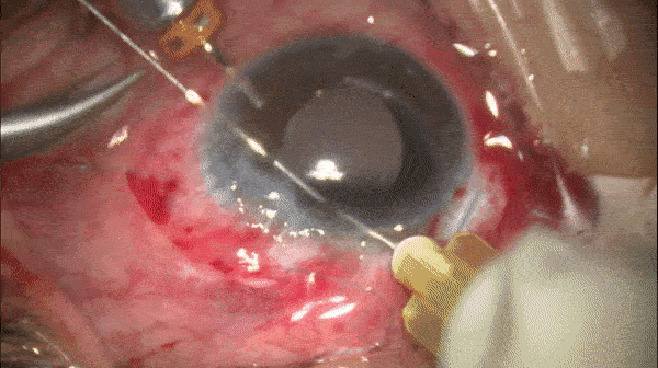 开睑器怎么用术说睛彩 ｜ 金海鹰教授：使用8-0缝线的无巩膜瓣人工晶体固定手术_https://www.jmylbn.com_新闻资讯_第22张