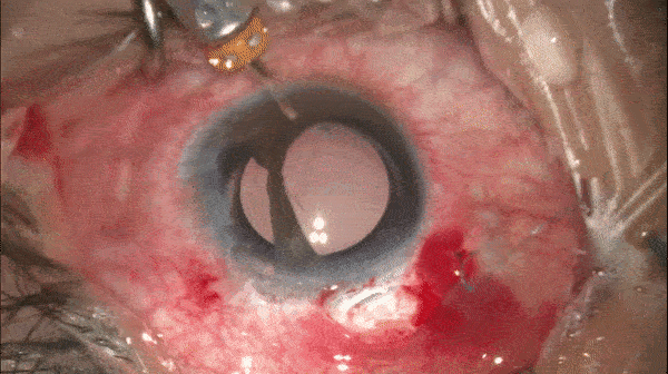 开睑器怎么用术说睛彩 ｜ 金海鹰教授：使用8-0缝线的无巩膜瓣人工晶体固定手术_https://www.jmylbn.com_新闻资讯_第12张