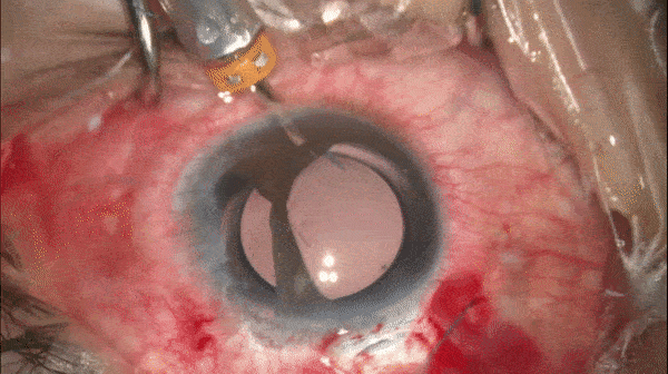 开睑器怎么用术说睛彩 ｜ 金海鹰教授：使用8-0缝线的无巩膜瓣人工晶体固定手术_https://www.jmylbn.com_新闻资讯_第11张