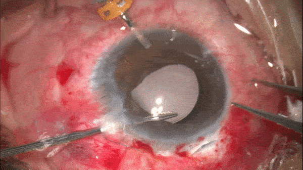 开睑器怎么用术说睛彩 ｜ 金海鹰教授：使用8-0缝线的无巩膜瓣人工晶体固定手术_https://www.jmylbn.com_新闻资讯_第24张