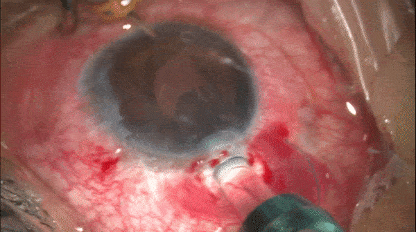 开睑器怎么用术说睛彩 ｜ 金海鹰教授：使用8-0缝线的无巩膜瓣人工晶体固定手术_https://www.jmylbn.com_新闻资讯_第6张