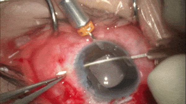 开睑器怎么用术说睛彩 ｜ 金海鹰教授：使用8-0缝线的无巩膜瓣人工晶体固定手术_https://www.jmylbn.com_新闻资讯_第17张