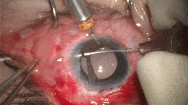 开睑器怎么用术说睛彩 ｜ 金海鹰教授：使用8-0缝线的无巩膜瓣人工晶体固定手术_https://www.jmylbn.com_新闻资讯_第18张