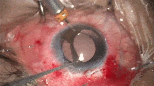 开睑器怎么用术说睛彩 ｜ 金海鹰教授：使用8-0缝线的无巩膜瓣人工晶体固定手术_https://www.jmylbn.com_新闻资讯_第14张