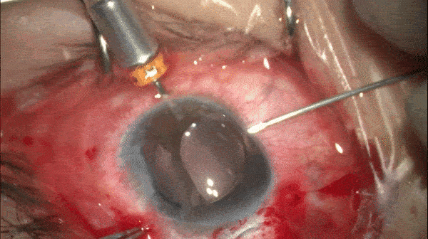 开睑器怎么用术说睛彩 ｜ 金海鹰教授：使用8-0缝线的无巩膜瓣人工晶体固定手术_https://www.jmylbn.com_新闻资讯_第16张