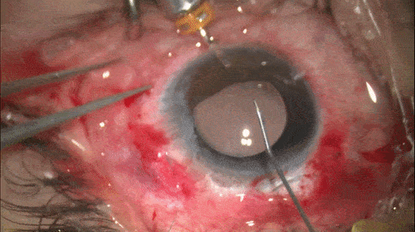 开睑器怎么用术说睛彩 ｜ 金海鹰教授：使用8-0缝线的无巩膜瓣人工晶体固定手术_https://www.jmylbn.com_新闻资讯_第21张