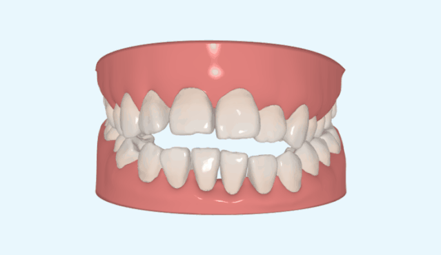 医生，我戴牙套一个月了还是没变化，可以加快速度吗？