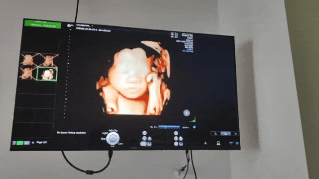 汕头彩超怎么样太赞了！双屏看宝宝，大屏更清晰，家属还能陪同~_https://www.jmylbn.com_新闻资讯_第3张