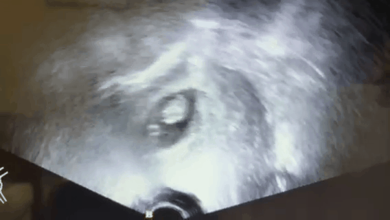 超声引导人流是什么【科普】带您了解“睡一觉”就可完成的无痛人流是怎么进行的。_https://www.jmylbn.com_新闻资讯_第11张