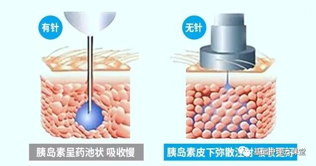 注射器干什么用无针注射器你有了解多少？_https://www.jmylbn.com_新闻资讯_第6张
