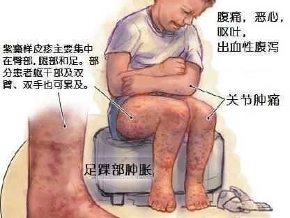 过敏性紫癜又称iga血管炎或亨-舒综合征,是一种常见的血管变态反应性