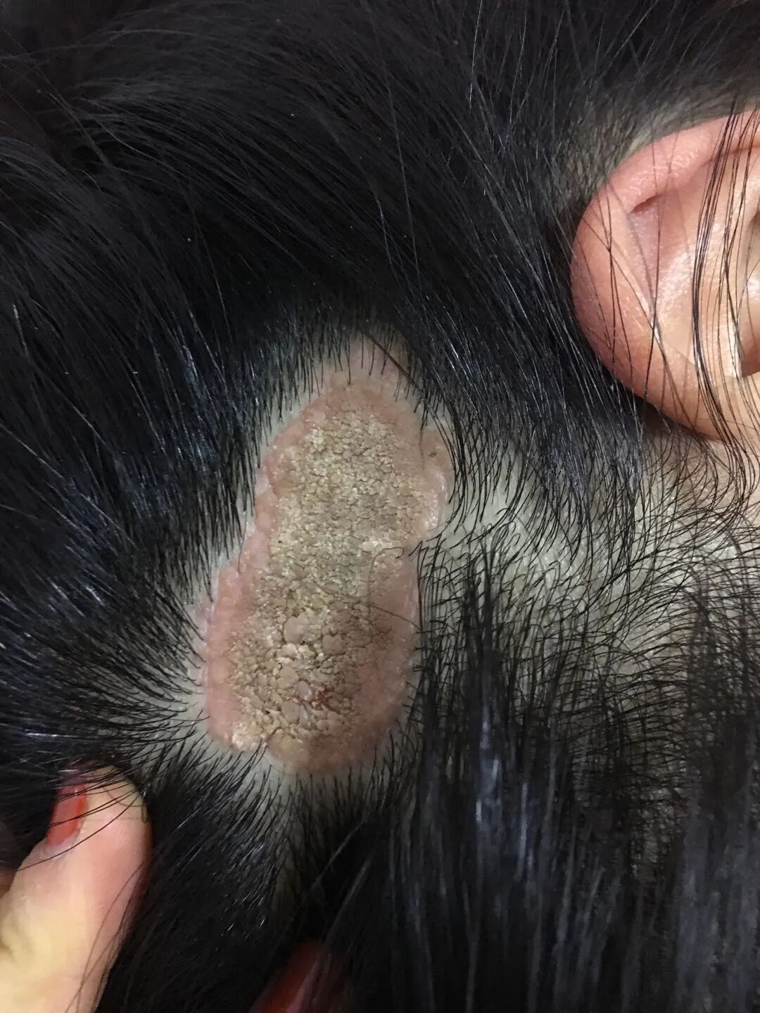 今天,小皮咖就带大家来了解一下这个疾病——皮脂腺痣皮脂腺痣又称