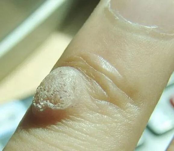 特殊部位寻常疣--二氧化碳激光治疗法