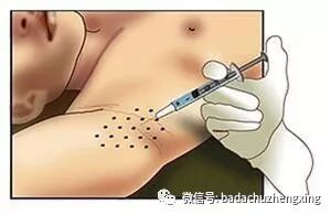 微波治疗机怎么使用天气热了，尴尬的腋臭多汗症_https://www.jmylbn.com_新闻资讯_第6张