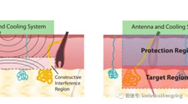 微波治疗机怎么使用天气热了，尴尬的腋臭多汗症_https://www.jmylbn.com_新闻资讯_第11张