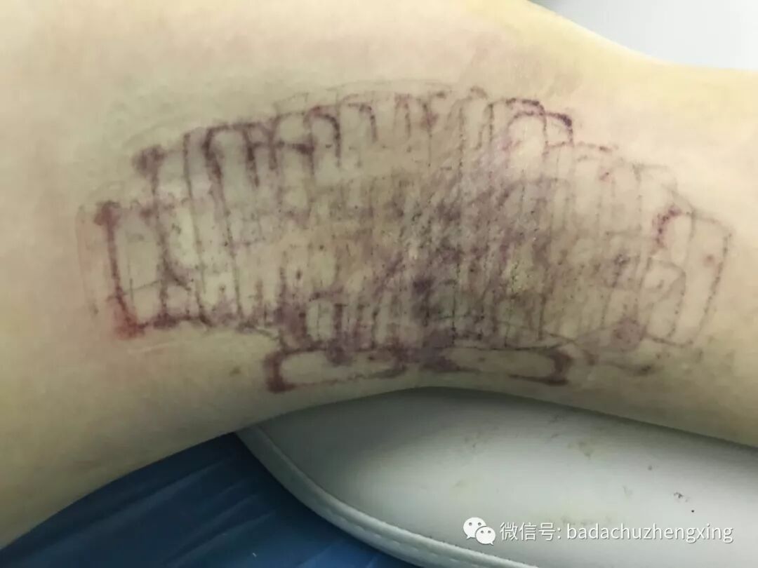 微波治疗机怎么使用天气热了，尴尬的腋臭多汗症_https://www.jmylbn.com_新闻资讯_第16张