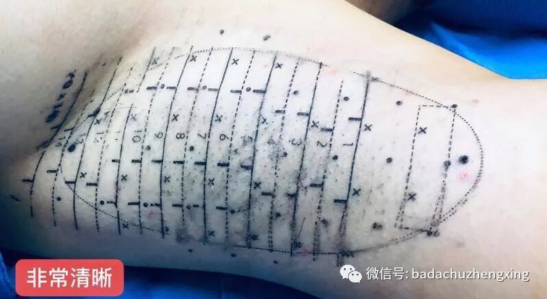 微波治疗机怎么使用天气热了，尴尬的腋臭多汗症_https://www.jmylbn.com_新闻资讯_第15张