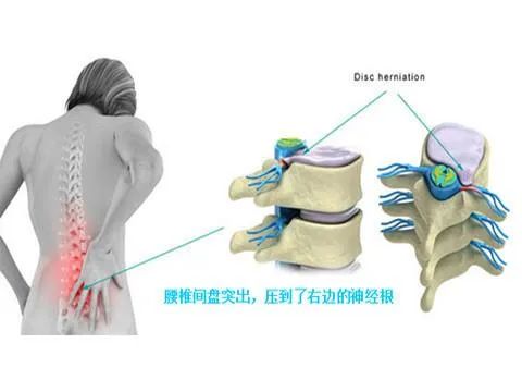 腰椎間盤突出症的不同病程非手術療法應注意什麼