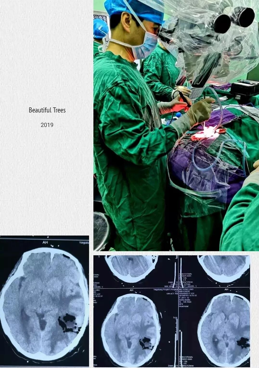 省立颍医神经外科成功完成一例脑胶质瘤手术