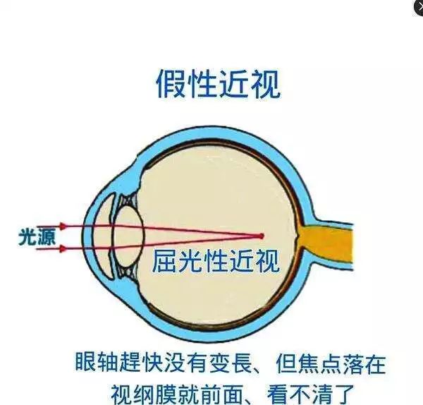 “真假”近视分不清？区别看这里