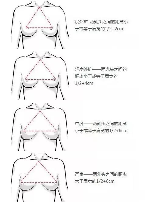 胸外扩怎么判断 用这4点让它 改邪归正 遇见欧姐 微信公众号文章阅读 Wemp